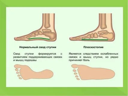 Свод стопы