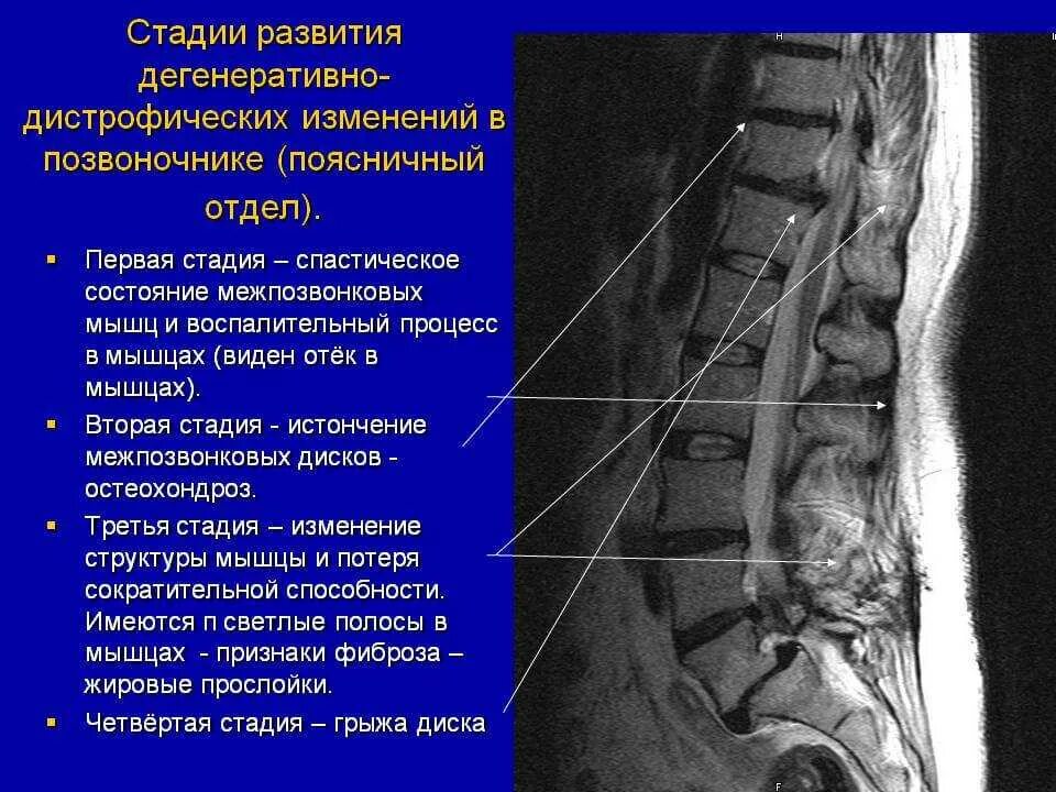 Дистрофические изменения позвоночника