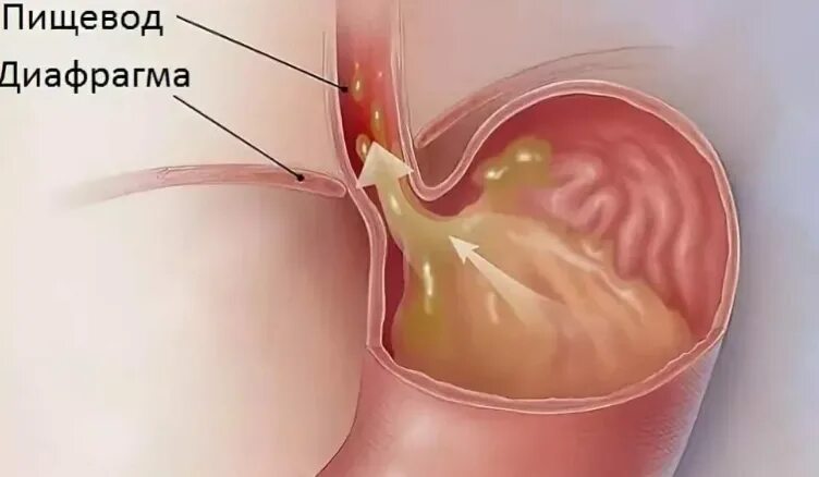 Заброс содержимого желудка в пищевод. Рефлюкс маточной крови. Рефлюксе фото.