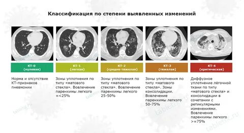 Пневмония симптомы как распознать