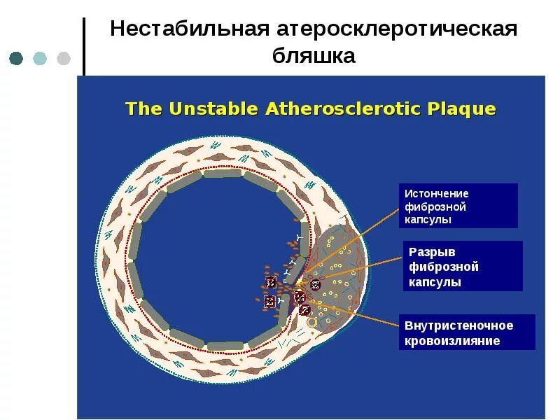 Разрыв бляшки. Строение стабильной и нестабильной атеросклеротической бляшки. Нестабильная атеросклеротическая бляшка. Признаки нестабильной бляшки.