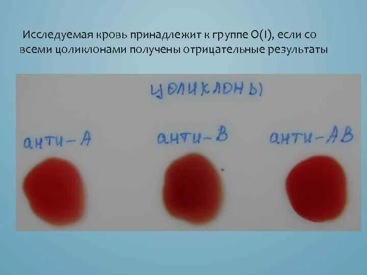 Группа крови Цоликлоны резус фактор. Цоликлон анти а1 гематолог. Цоликлон анти а1 интерпретация результатов. Анти Цоликлоны для определения групп крови.