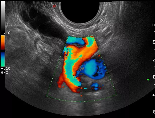 Варикоз органов таза у женщин. Варикоз вен малого таза эхограмма. Расширение вен малого таза УЗИ. Варикозное расширение вен малого таза УЗИ. УЗИ малого таза варикозное расширение.