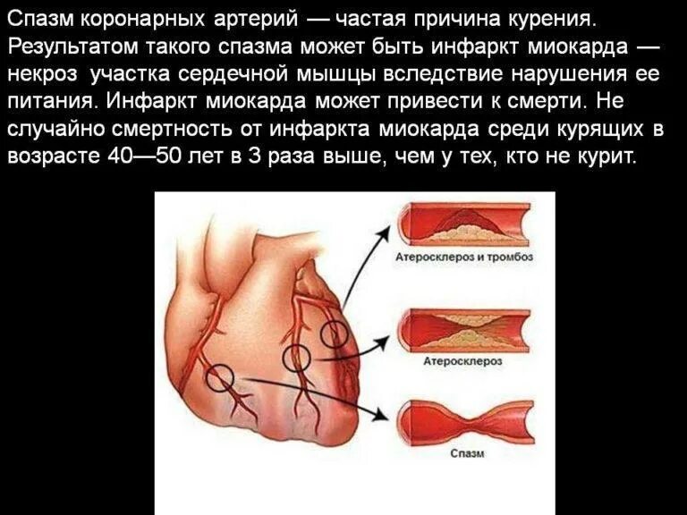 Спазм коронарных артерий. Причины спазма коронарных артерий. Спазм венечных артерий. Спазм коронарных артерий причины.