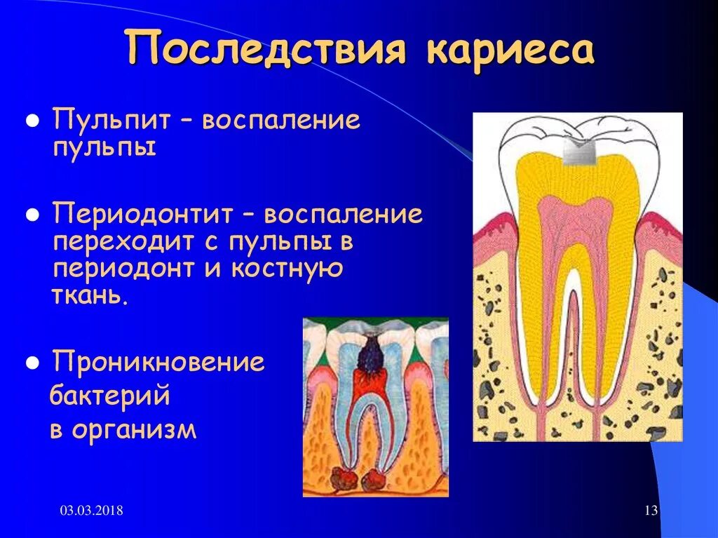 Осложнения лечения пульпита. Периодонтит гипертрофический периодонтит. Периодонтит осложненный кариес. Кариес пульпит периодонтит. Осложнения кариеса периодонтит.