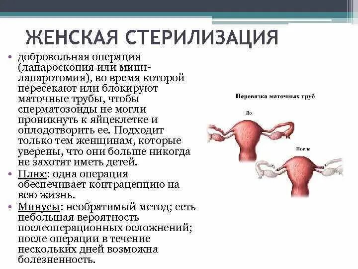 Стерилизация женщин. Плюсы и минусы стерилизации - YouTube