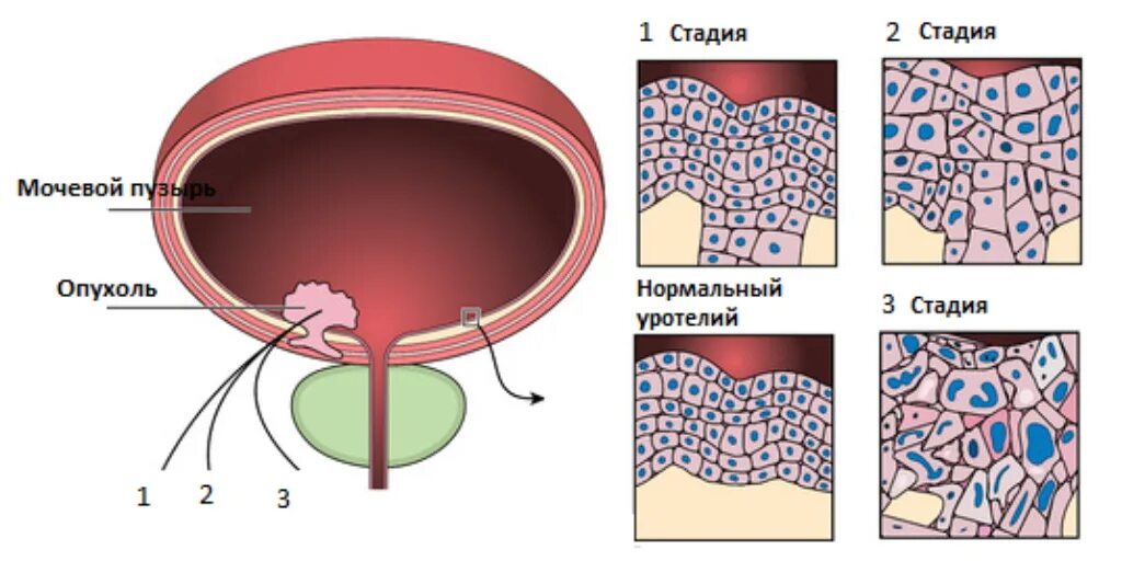 Опухоли мочевого пузыря патогенез. Новообразования мочевого пузыря классификация. Злокачественные новообразования мочевого пузыря классификация. Клинические проявления опухоли мочевого пузыря. Операция рака мочевого пузыря у мужчин