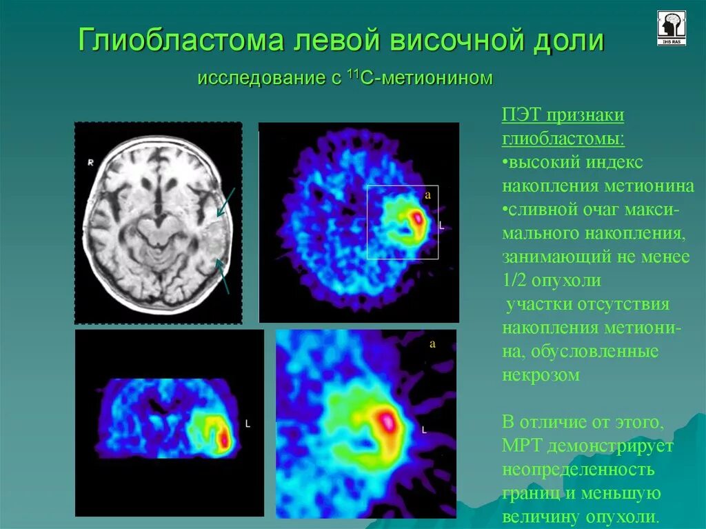 Пэт с тирозином. ПЭТ- позитронно-эмиссионная томография головы. Позитронно-эмиссионная томография. Исследование ЦНС. Позитронно-эмиссионная томография опухоли. ПЭТ кт опухоли головного мозга.