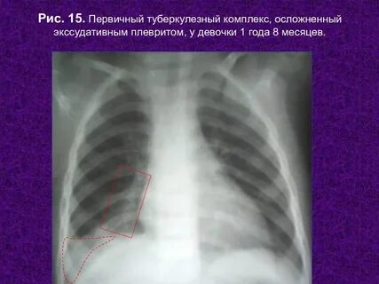 Плеврит у детей