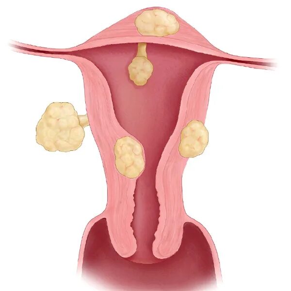 Доброкачественная опухоль миома. Миомы и фибромиомы матки. Миома от чего появляется матки у женщин