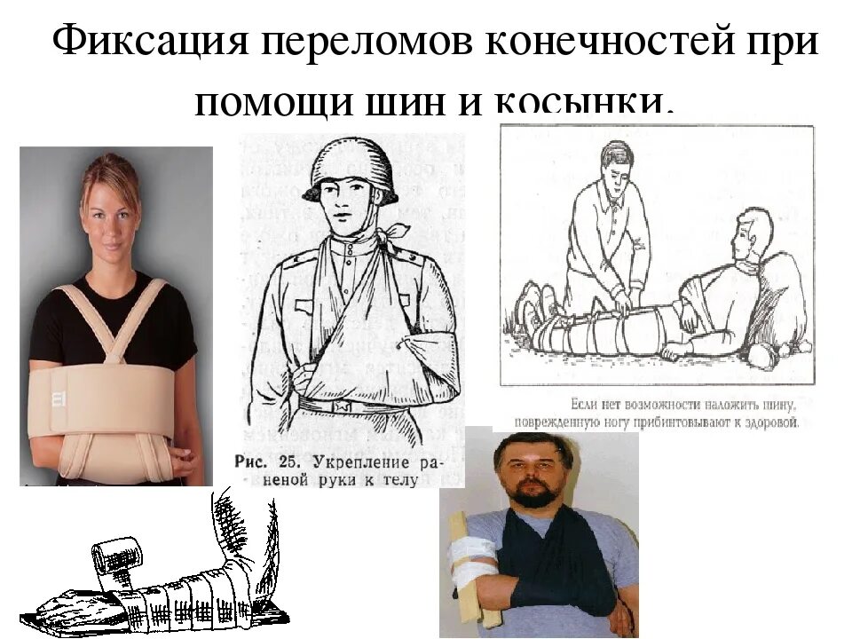 Фиксация конечностей при переломах. Фиксирование конечностей при переломе. Фиксация руки при переломе. Фиксирование ноги при переломе.