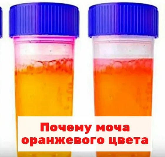 Почему моча оранжевая у женщин. Оранжевая моча. моча насыщенного оранжевого цвета. моча темно оранжевого цвета. моча с оранжевым оттенком.