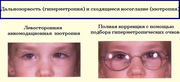 Косоглазие симптомы. Косоглазие при гиперметропии. дальнозоркость и сходящееся косоглазие. косоглазие и дальнозоркость у детей. гиперметропия при содружественном косоглазии.