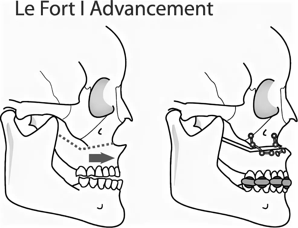 Le fort. Ле фор 1 остеотомия верхней челюсти. Остеотомия верхней челюсти по le Fort 1.