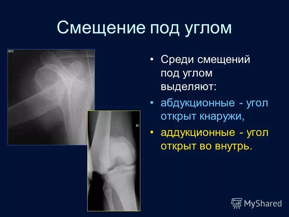 как линейкой измерить угол 90 градусов. перелом большеберцовой кости рентген. открыт под углом в. угловое смещение отломков рентген. Vauth sagel карусель верхняя угловая.