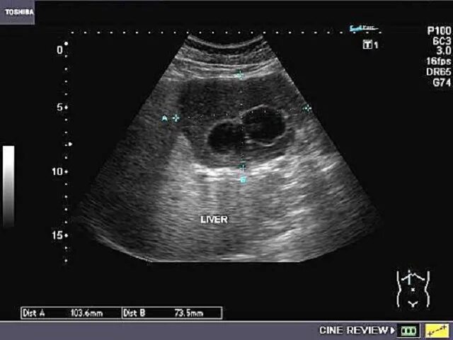 узи протоков печени. узи поджелудочной железы изранов. ворота печени на узи. расширенный проток желчного пузыря. сонография желчного пузыря.