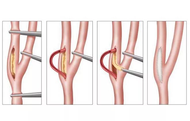 Шунтирование нижних конечностей. Эндоваскулярная эндартерэктомия. Шунтирование сонной артерии. Операция каротидная эндартерэктомия.