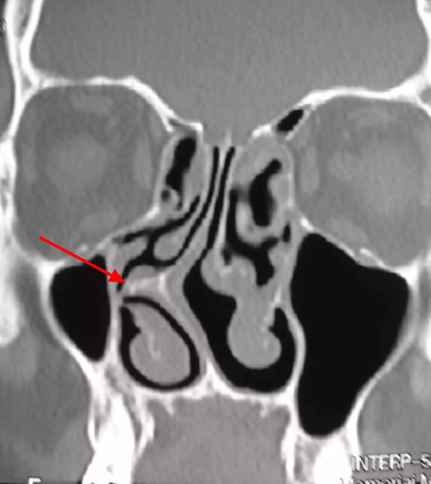 Гребень перегородки. Перфорация носовой перегородки на кт. Кривая носовая перегородка на кт. Перфорация носовой перегородки рентген. Кт искривленной носовой перегородки.