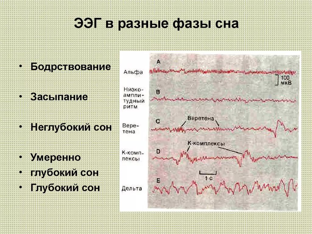 Видео ээг ночной. ЭЭГ-корреляты фаз сна.. Фазы и стадии сна ЭЭГ. Стадии сна параметры ЭЭГ. Фазы сна на ЭЭГ.