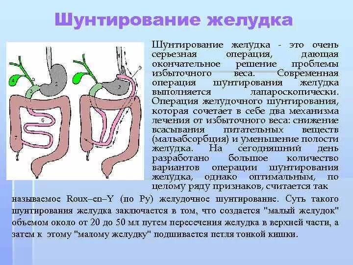 Последствия операции желудка. Операция шунтирование желудка. Лапароскопическое желудочное шунтирование. Мини желудочное шунтирование.