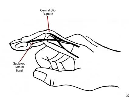 Finger slip