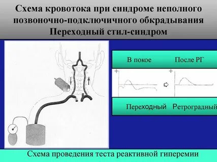 Обкрадывания подключичной артерии