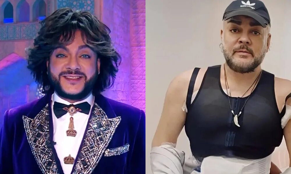 Киркоров после пластики фото сейчас. Киркоров после пластики фото сейчас