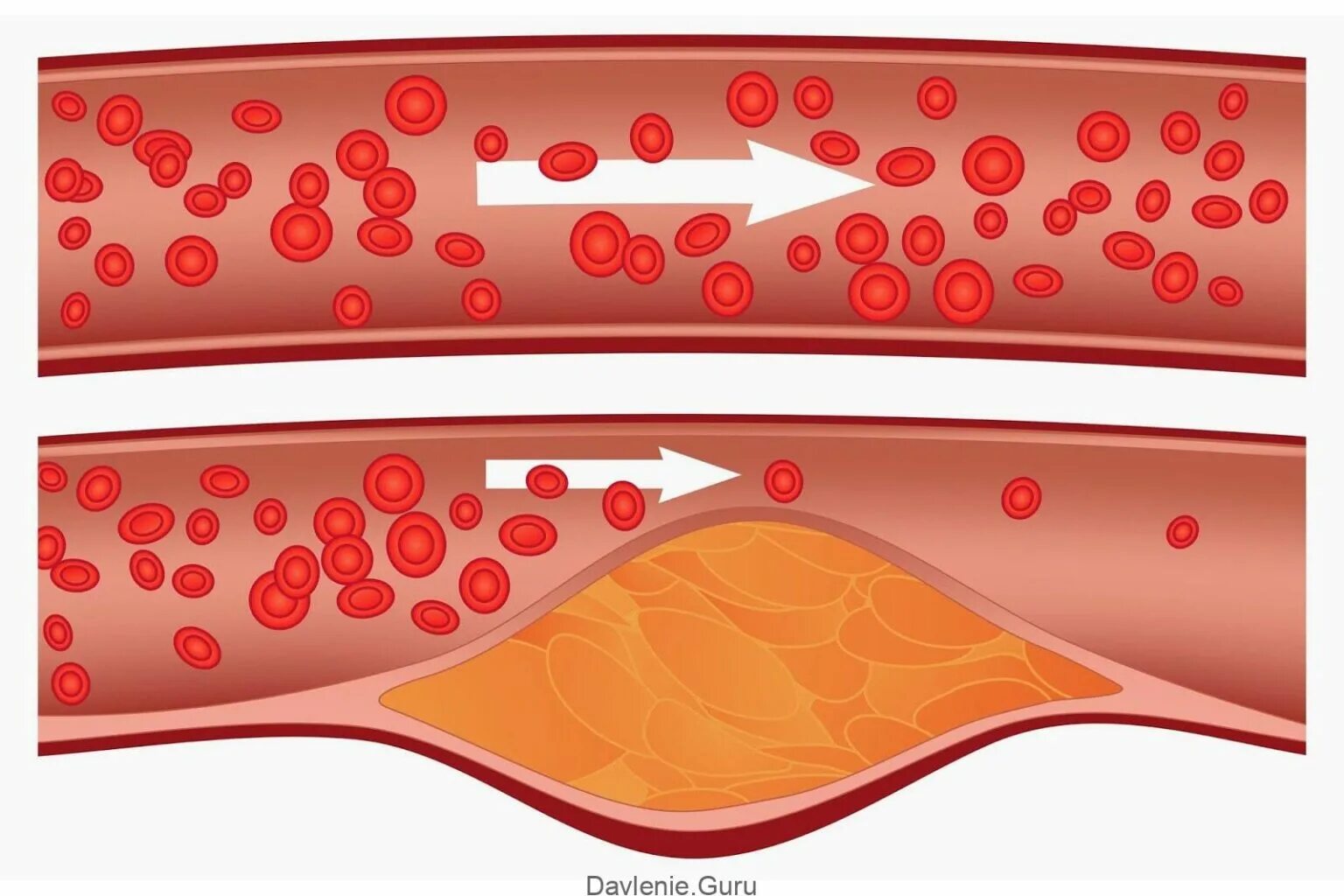 Атеросклероз (закупорка кровеносных сосудов). Атеросклерозная бляшка сосуда. Холестериновые бляшки в сосудах. Кровеносные сосуды с бляшками. Как очистить сосуды от холестериновых тромбов