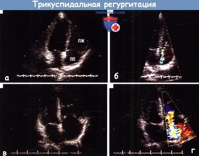 Трикуспидальный клапан регургитация 1 степени что это такое. Трикуспидальная регургитация степени. Градиент трикуспидальной регургитации норма. Степени регургитации митрального клапана. Симптомы трикуспидальной недостаточности.