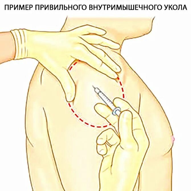 Подкожное введение вакцины. ВМ инъекции техника в плечо. Внутримышечная инъекция в плечо техника выполнения. Постановка внутримышечной инъекции в плечо. Укол внутримышечно в плечо схема.