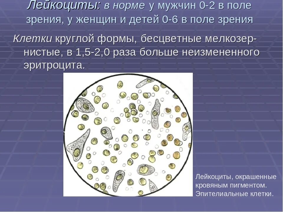 Лейкоциты в моче повышены у мужчины лечение. Лейкоциты в моче микроскопия осадка. Микроскопия мочи лейкоциты. Лейкоциты при микроскопия мочи. Лейкоциты в моче 2 тире 4.