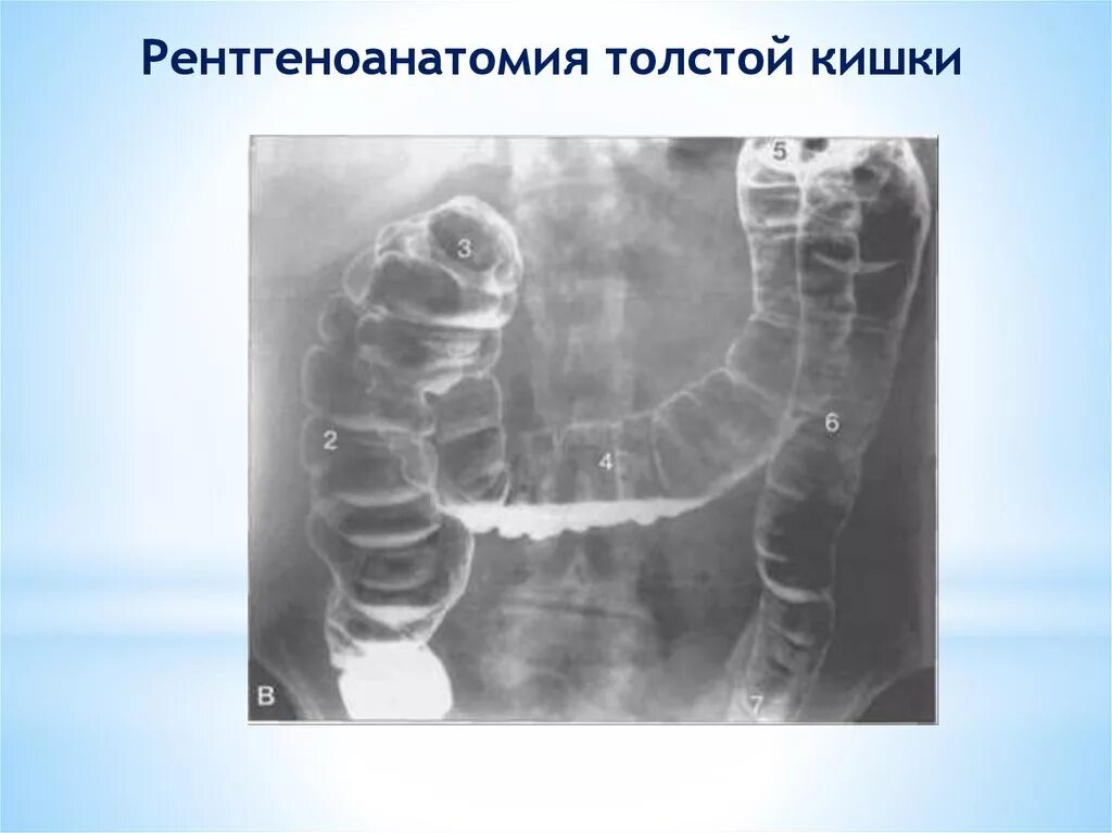 Слепая и ободочная кишка. Ирригоскопия опухоль сигмовидной кишки. Контрастирование Толстого кишечника рентген. Ирригоскопия сигмовидной кишки. Кишечная непроходимость ирригоскопия.