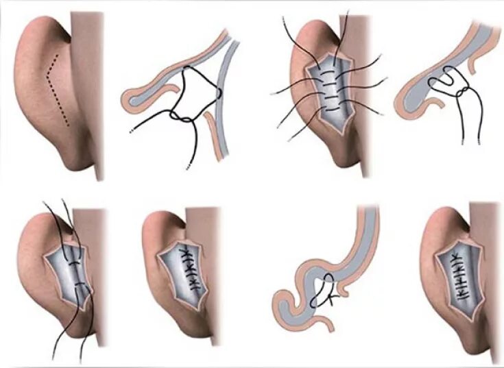 Операции на уши при лопоухости. Схема операции при лопоухости. Метод мустарда отопластика. Отопластика ход операции.
