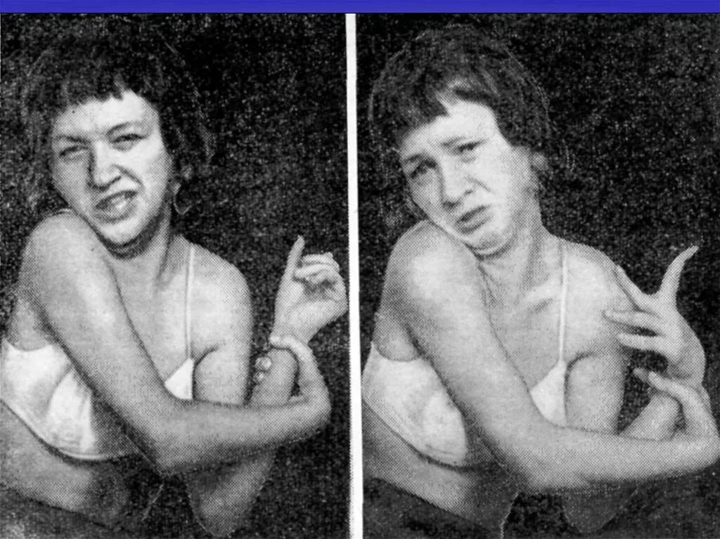 Мышечная дистония код. Болезнь гентингтона (хорея гентингтона). хорея сиденгама. гиперкинезы торсионная дистония.