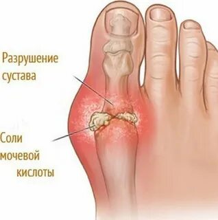 Кислота в ногах