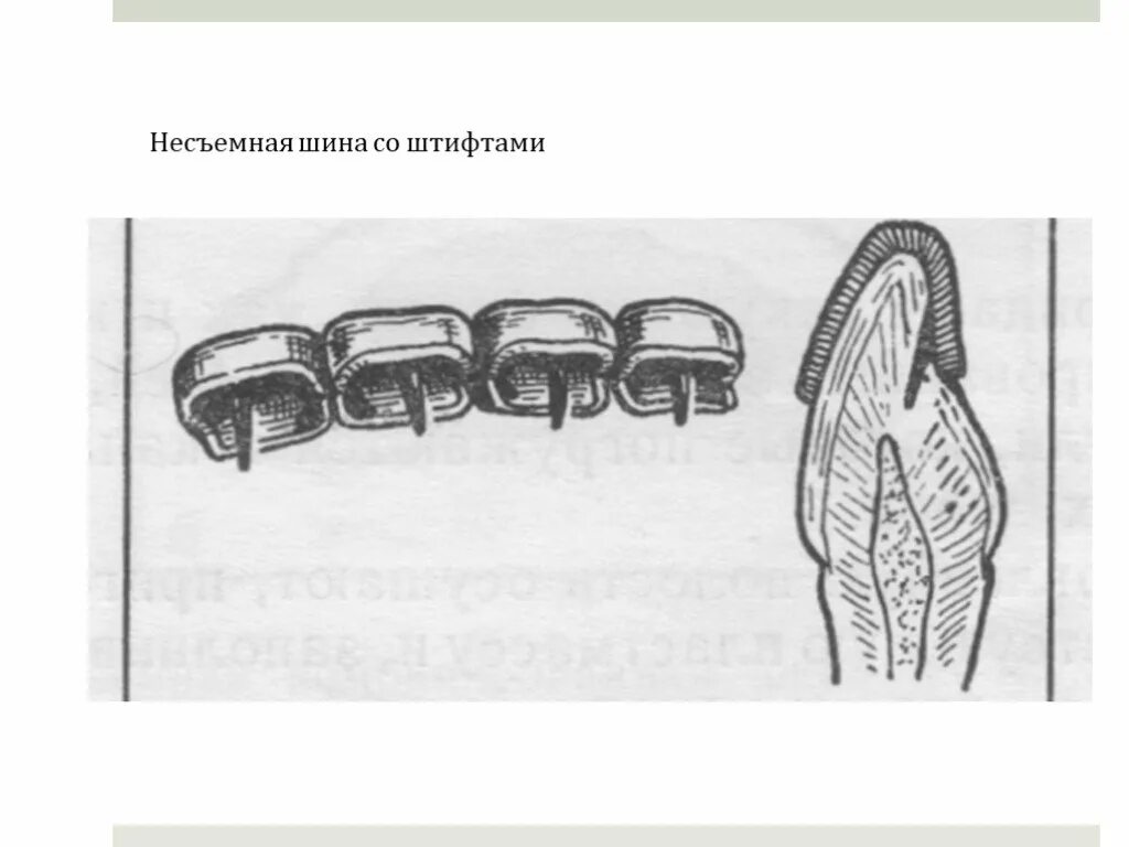 Кольцевая шина. Штифтовая шина Мамлока. Шина Мамлока в ортопедии. Шина Мамлока в стоматологии. Несъемные шины Мамлока.