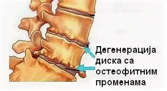Диск остеофит
