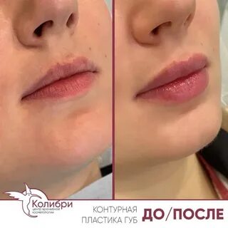 Пластика губ до и после фото