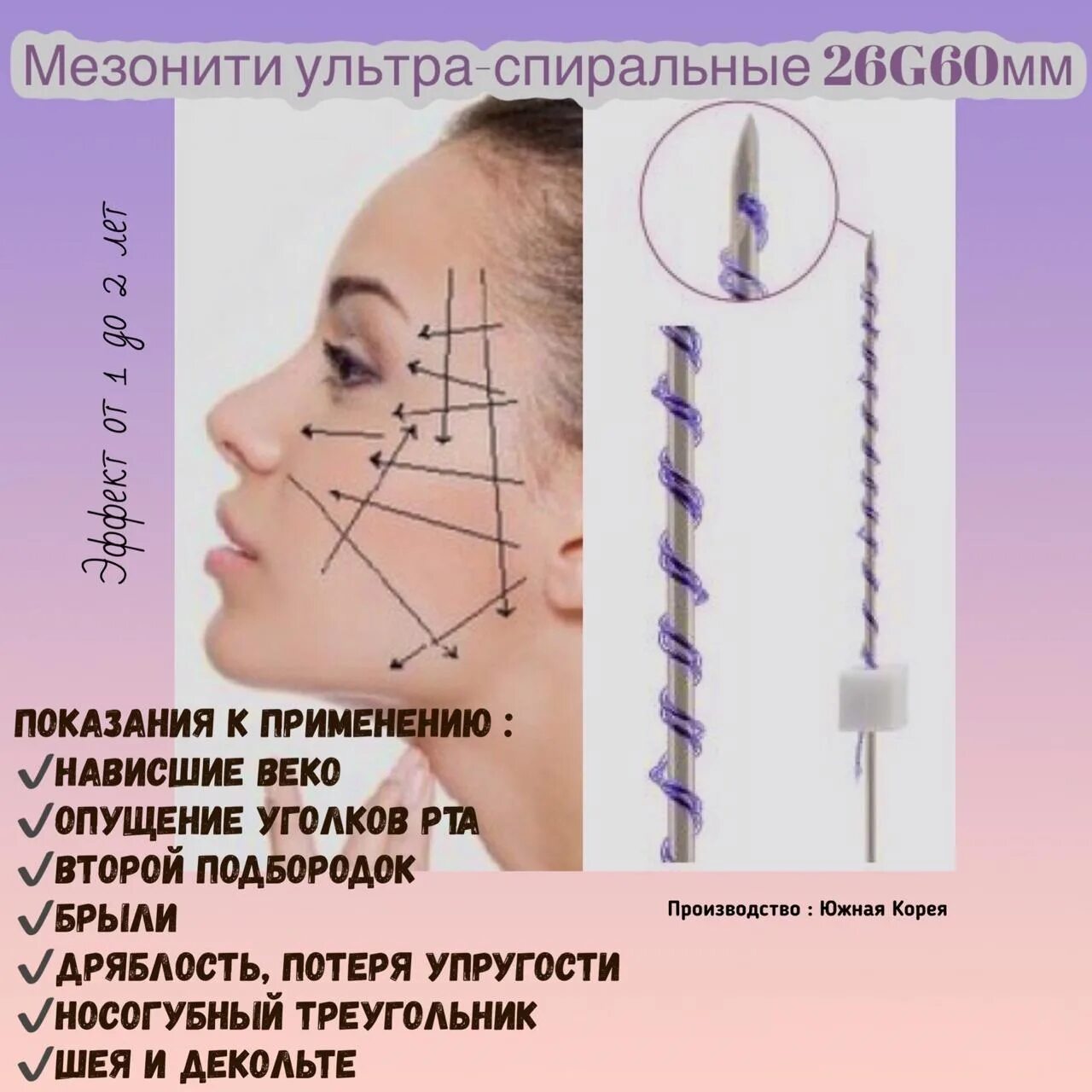 Мезонити 26g/100. Схемы армирования мезонитями. Нити спиральные для подтяжки. Спиральные нити для подтяжки лица.