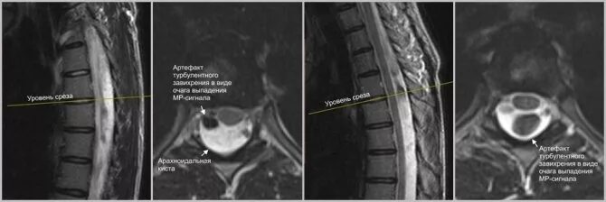 Арахноидальная киста позвоночника s2. Периневральная киста грудного отдела позвоночника на мрт. Киста спинного мозга поясничного отдела мрт. Операция кисты позвоночника