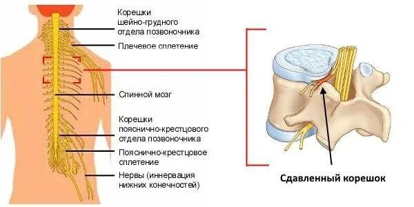 Защемление корешков в пояснице. Корешковый синдром грудного отдела. Защемление Корешков спинного мозга симптомы. Сдавление Корешков шейного отдела позвоночника. Сдавливание нервных Корешков в грудном отделе.