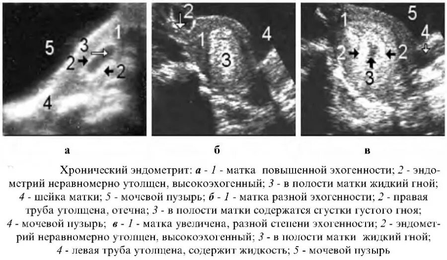 Узи признаки эндометриоза матки. Послеродовый эндометрит УЗИ. Признаки хронического эндометрита на УЗИ.