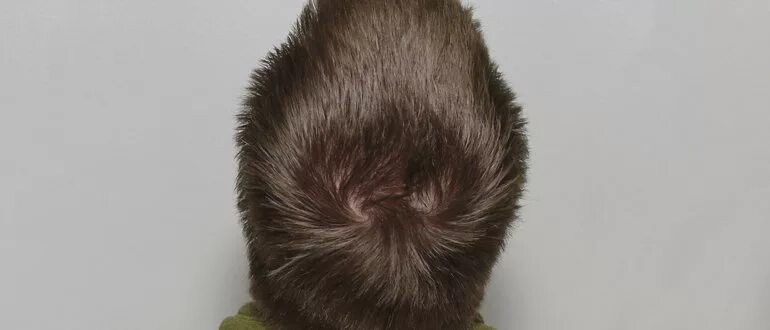 Дае макушкина голове. Три макушки. Длинные волосы с двумя макушками. Вихрь на волосах. Пятно на затылке у новорожденного.