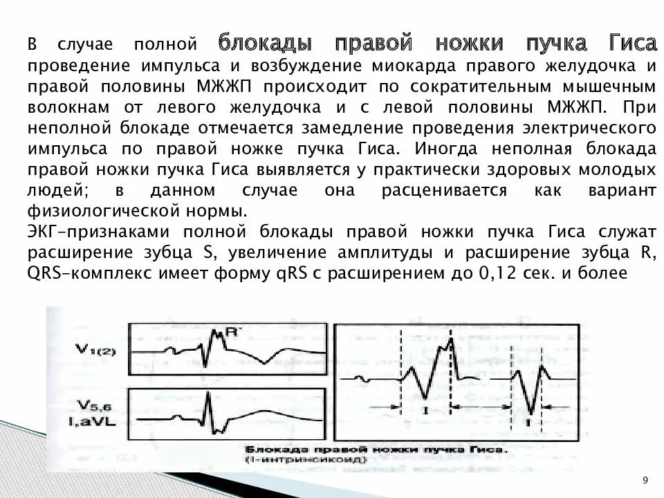 Неполная блокада правой ножки это опасно. Неполная блокада правой ножки пучка Гиса. Блокада проводимости пучка Гиса. Блокада правой ножки пучка Гиса на ЭКГ. Неполная блокада правой ножки пучка Гиса на ЭКГ.