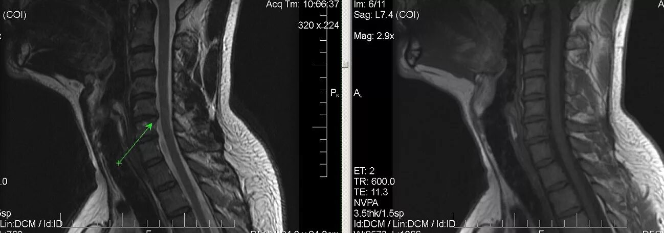 Мр картина дистрофических изменений поясничного отдела позвоночника. Дистрофически дегенеративные изменения позвоночника шейного отдела. Дегенеративные изменения позвоночника мрт. Дегенеративные изменения шейного отдела позвоночника рентген. Дегенеративные изменения позвоночника шейного отдела с2-с7.