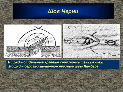 Шов 2