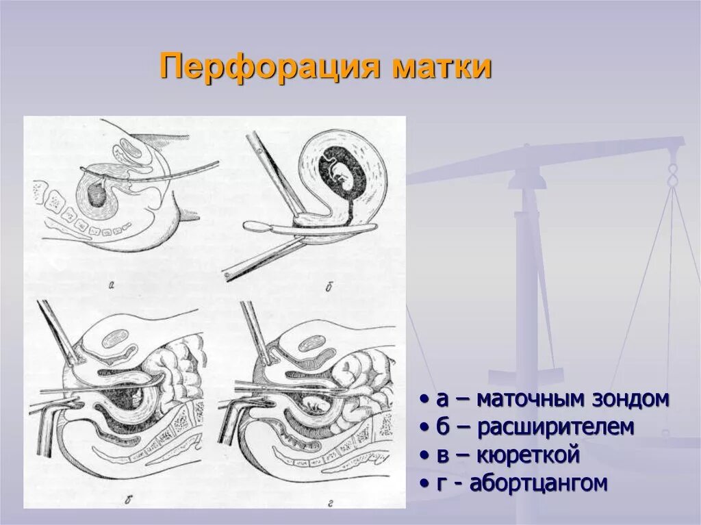 Форма полости матки. Перфорация стенки матки при аборте. Перфорация ВМС В стенку матки. Искусственный аборт перфорация матки. Признаки перфорации матки при аборте..