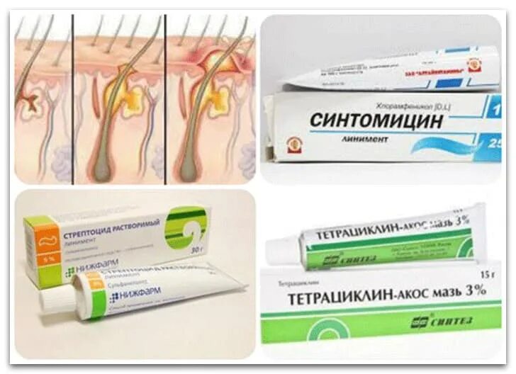 Что приложить чтобы вытянуть гной