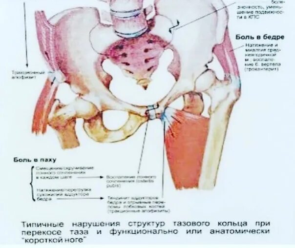 Болит таз мужчины. Положение таза. Перекос таза. Смещение таза. Искривление таза.