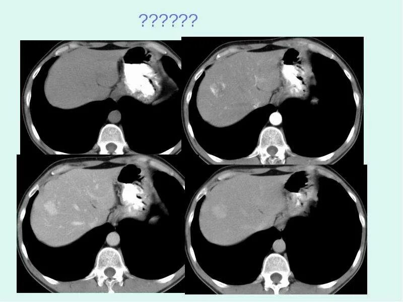 Альвеококкоз печени кт. Гиперваскулярные метастазы печени кт. Образования печени кт